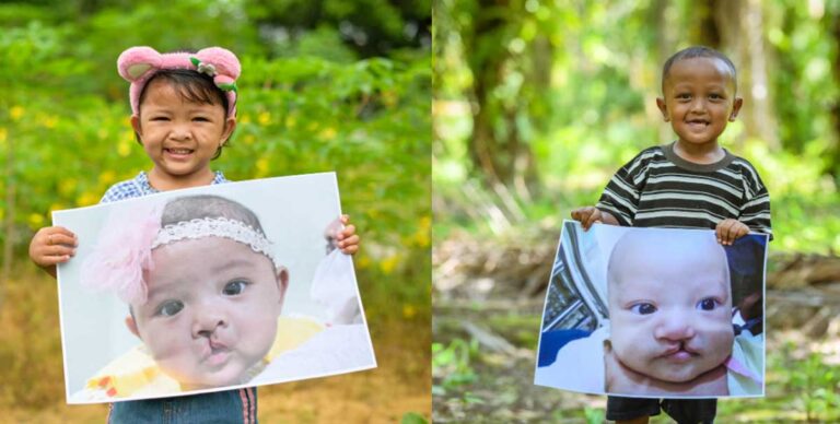 Two children who were recipients of Dentsply Sirona and Smile Train cleft care