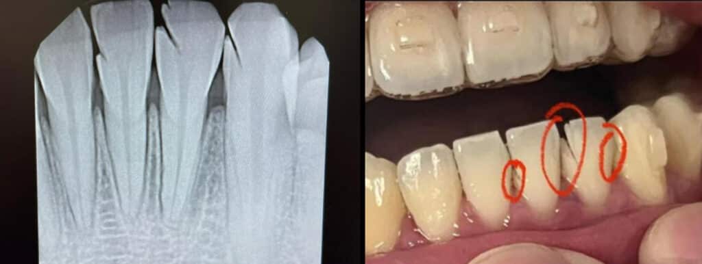 Figure 1: Damage to teeth with improper use of discs