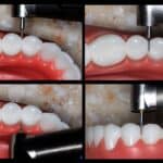 New IPR Bur System Simplifies Space-Gaining Requirements