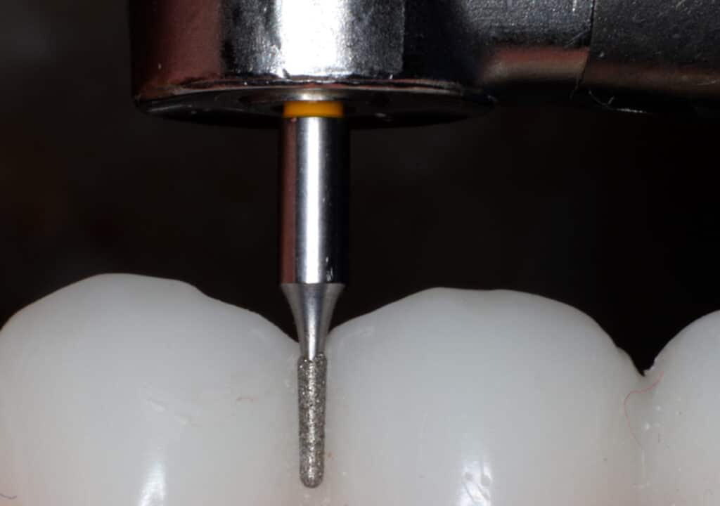 Figure 6: Cali-Bur lacks diamond on collar to maintain incisal edge integrity.