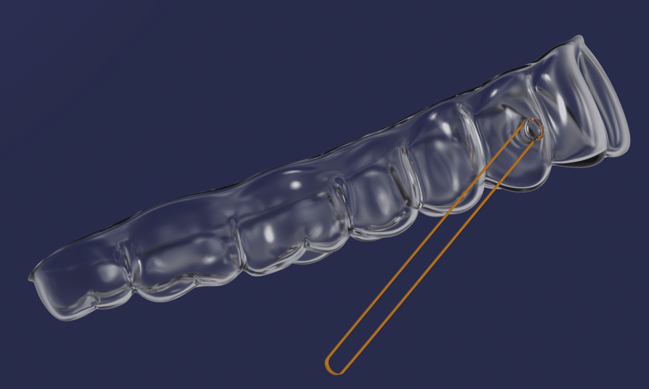 OrthoFX Launches Built-In Buttons for Clear Aligners