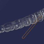 OrthoFX Launches Built-In Buttons for Clear Aligners