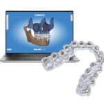 Inside DIBS AI Version 9.0: How Machine Learning is Automating the Heavy Lifting of Indirect Bonding