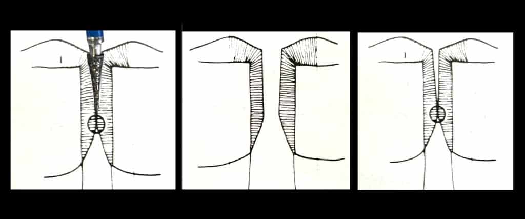 Figure 3: Tapered contact from flame-shaped IPR bur
