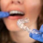 How Three Orthodontists Achieved Faster Finishes and Fewer Refinements With Spark Aligners