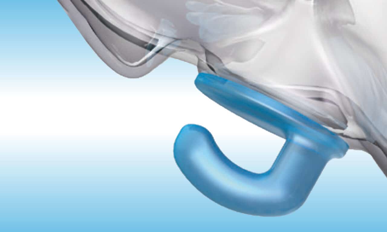 Streamlining Maxillary Protraction in Growing Patients with angelHook