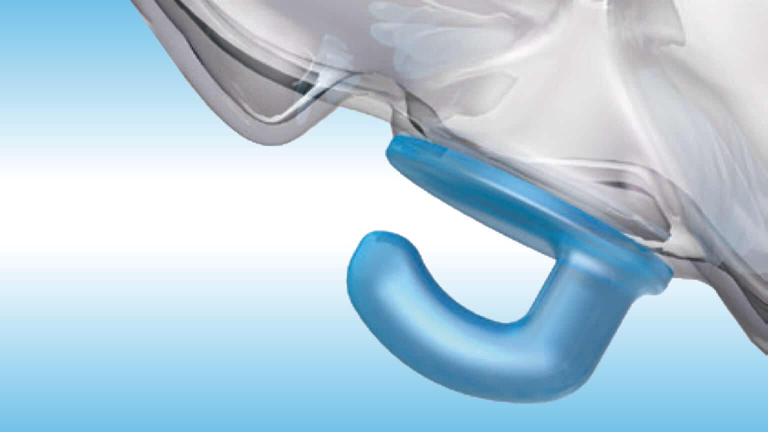 Inside Angel Aligner’s Strategy for the U.S. Orthodontic Market