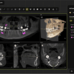 New AI Tool from Dentsply Sirona Targets Periapical Radiolucencies in 3D Scans