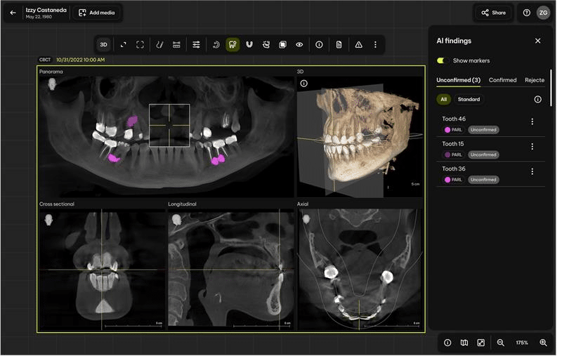 New AI Tool from Dentsply Sirona Targets Periapical Radiolucencies in 3D Scans