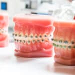 Focus on Bracket Systems