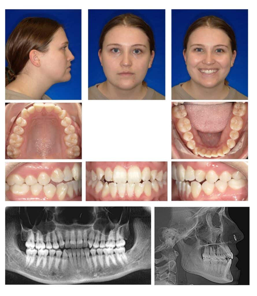 Figure 4. A 23-year-old adult Edge on Class III patient with TMD as the chief complaint and upper and lower crowding.
