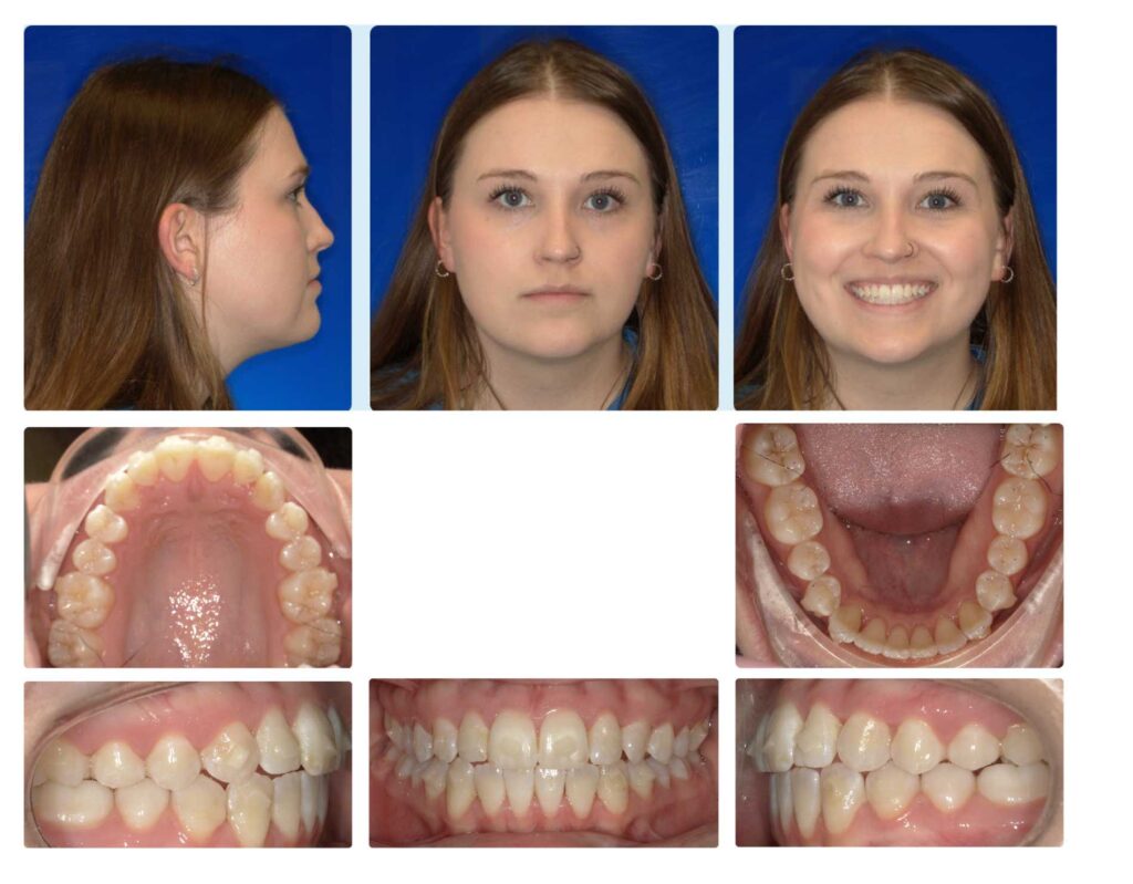 Figure 6: Progress records – first refinement.