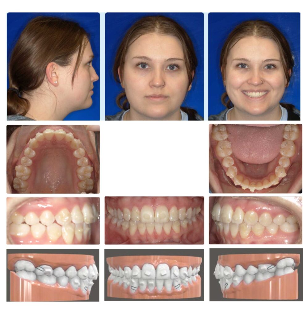 Figure 7. Progress records – second refinement.