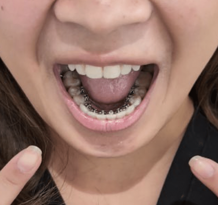 InSmile Braces shown in a patient's mouth.