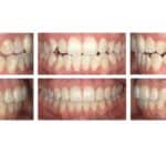 Optimizing Fit and Finish with FXClear Aligners