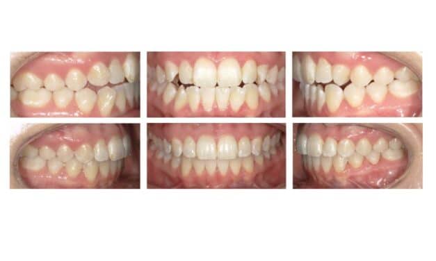Optimizing Fit and Finish with FXClear Aligners
