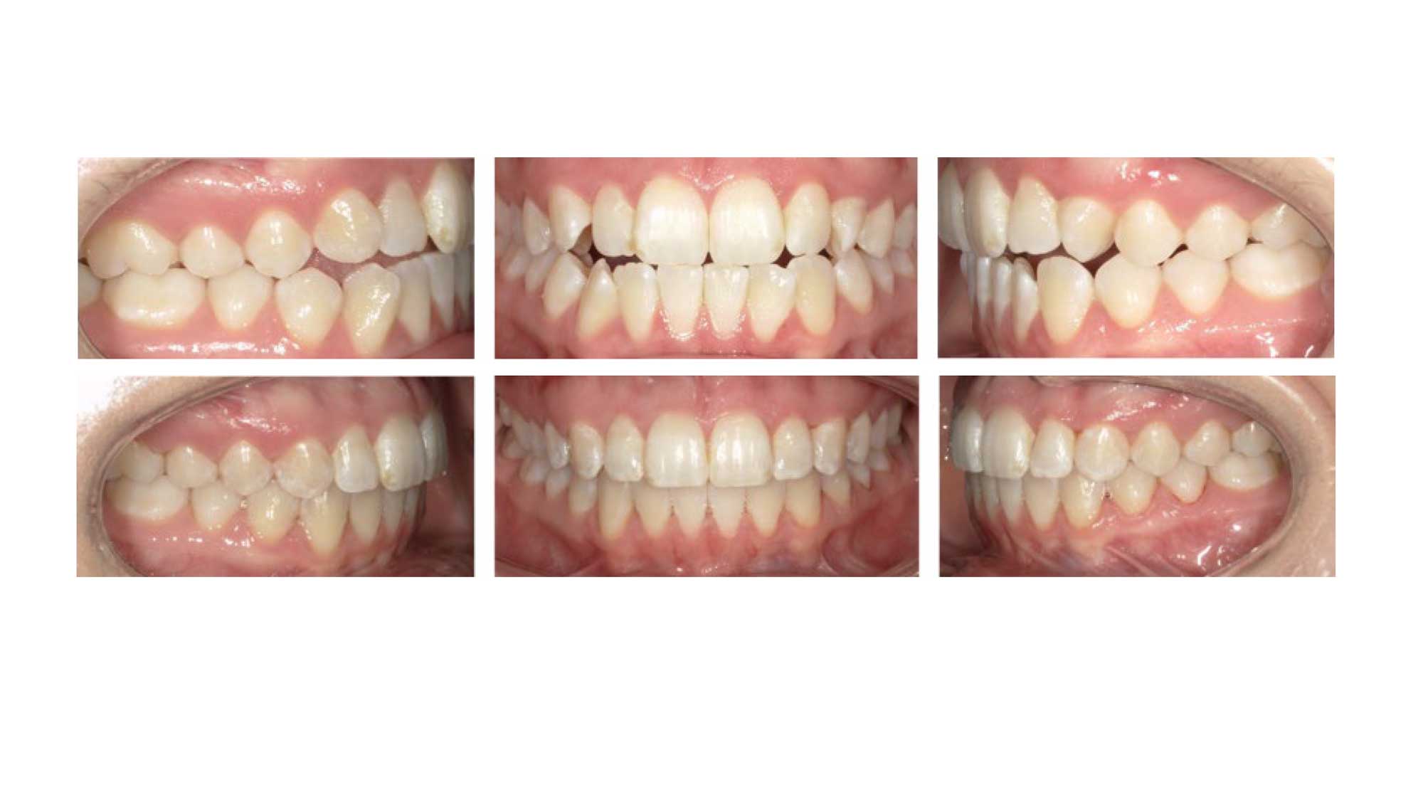 Optimizing Fit and Finish with FXClear Aligners