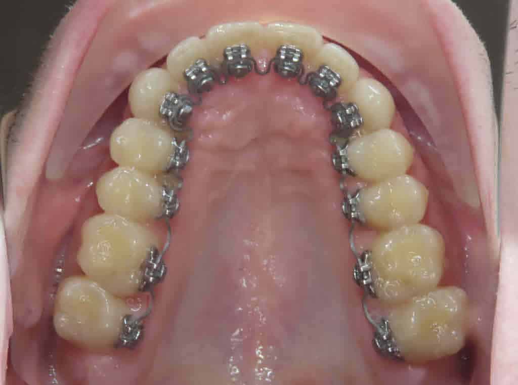 InSmile Braces shown on the upper occlusal