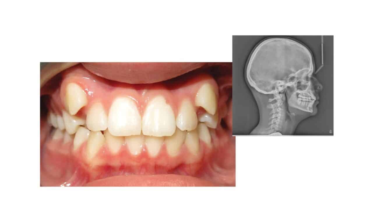 Managing Complex Class II Malocclusions in Teens with Clear Aligners