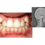 Managing Complex Class II Malocclusions in Teens with Clear Aligners