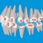 Streamlining Class II Correction in Growing Patients with a Single-Phase Mandibular Advancement Aligner