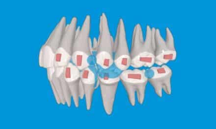 Streamlining Class II Correction in Growing Patients with a Single-Phase Mandibular Advancement Aligner