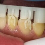 The Impact of Invisalign Specifix Attachment System on Orthodontic Outcomes and Practice Efficiency 