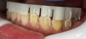The Specifix attachments are 3D printed to the precise shape, size and accurate location per the doctor’s ClinCheck treatment plan. They are made from a fully-cured photo-polymerized proprietary resin with no composite or template filling needed.