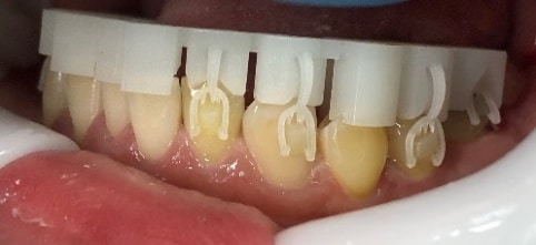 The Impact of Invisalign Specifix Attachment System on Orthodontic Outcomes and Practice Efficiency 