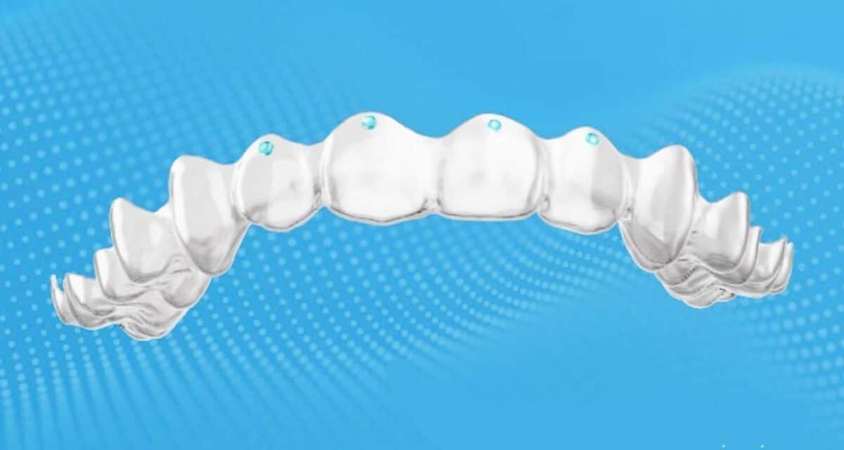 Angel Aligner Pressure Points feature European release