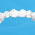 Angel Aligner Introduces Pressure Points Feature for Clear Aligners in Europe