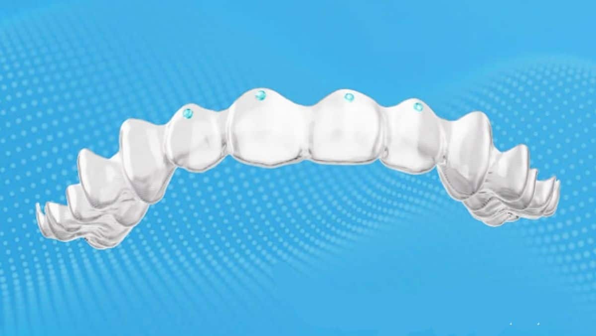 Angel Aligner Introduces Pressure Points Feature for Clear Aligners in Europe